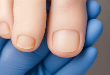 Czy podolog zajmuje się grzybicą stóp? Sprawdzamy, kiedy warto zgłosić się do specjalisty Czy podolog zajmuje się grzybicą stóp