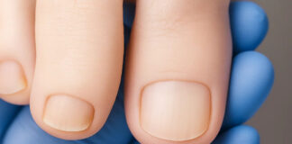 Czy podolog zajmuje się grzybicą stóp